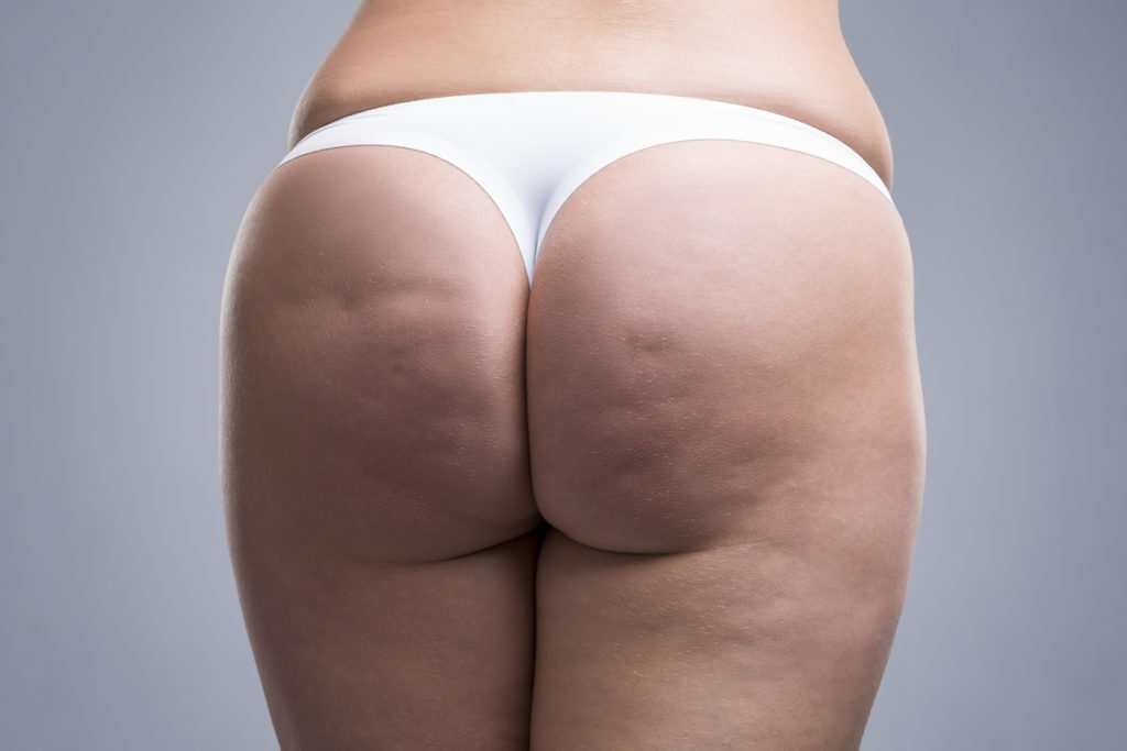 laser lipo Chicago eliminate cellulite TushToners