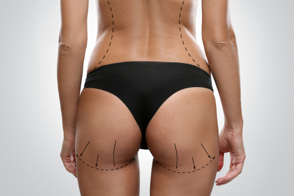 dangers of Brazilian butt lift surgery