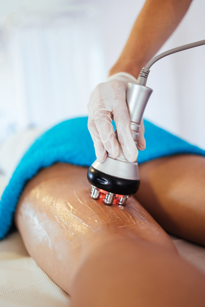 ultrasonic body cavitation chicago