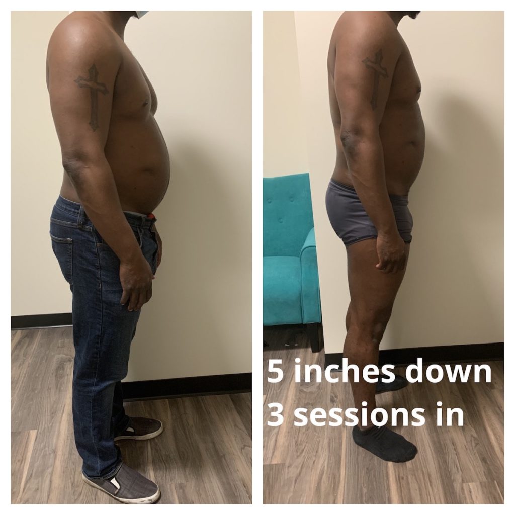 weight loss Chicago body contouring before and after