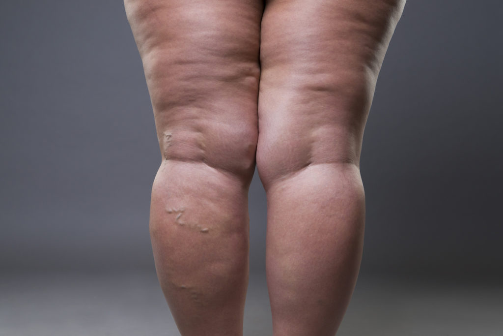 cellulite reduction treatment Chicago TushToners