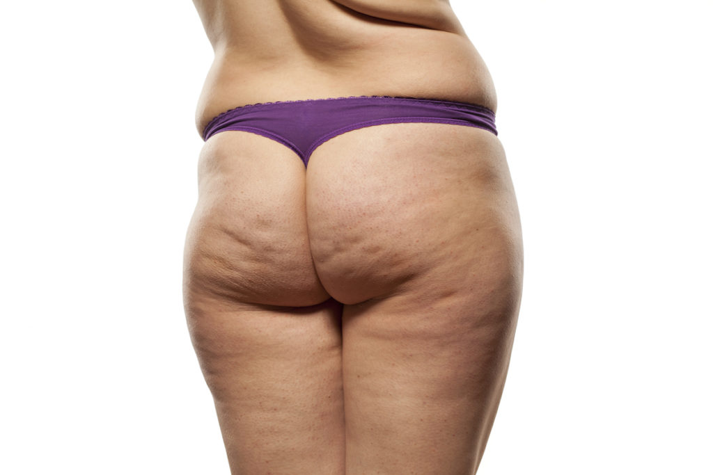 cellulite reduction body contouring Chicago TushToners