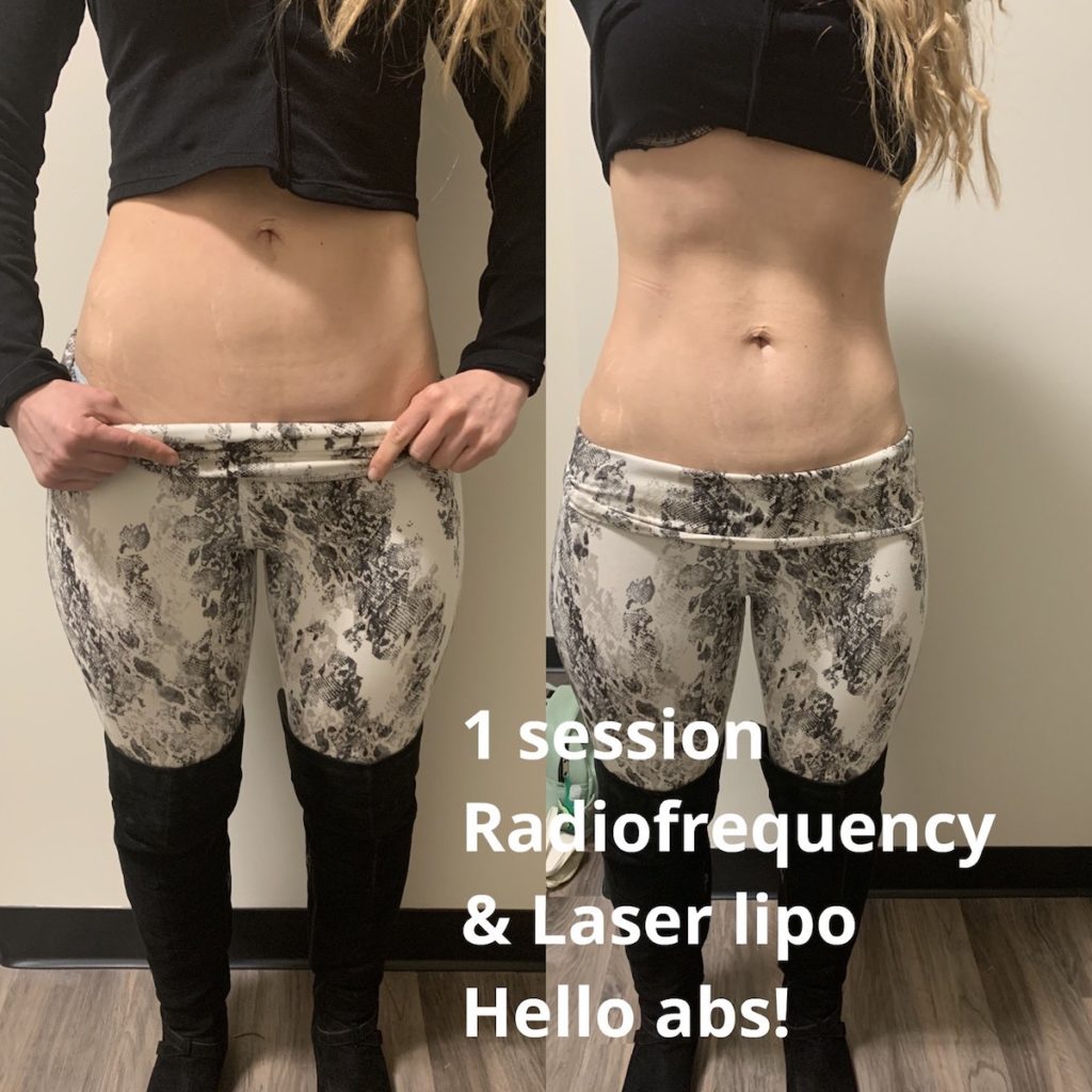 weight loss Chicago body contouring before and after