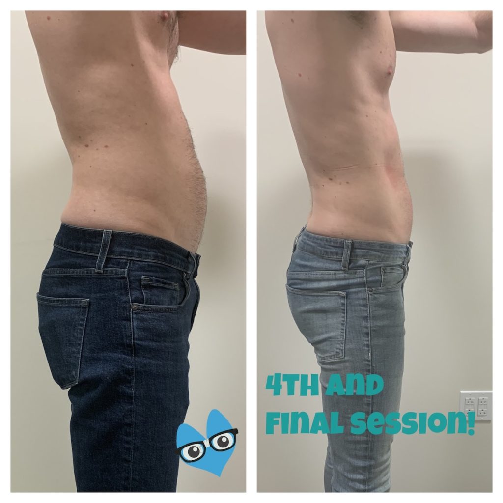 weight loss Chicago body contouring before and after