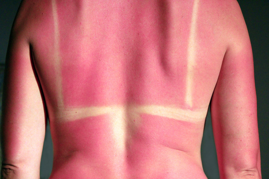 radiofrequency sunburn Chicago body sculpting