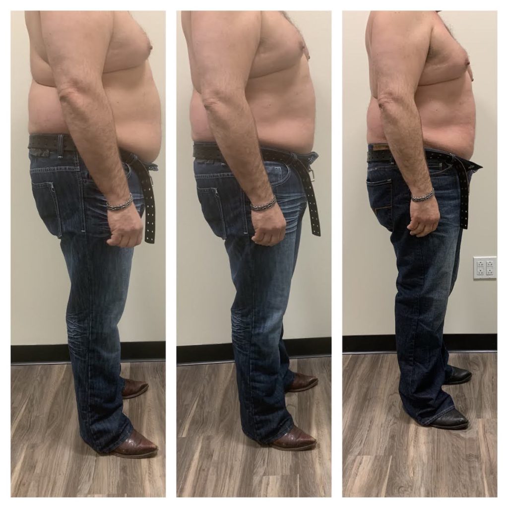 non invasive body contouring vs liposuction Chicago