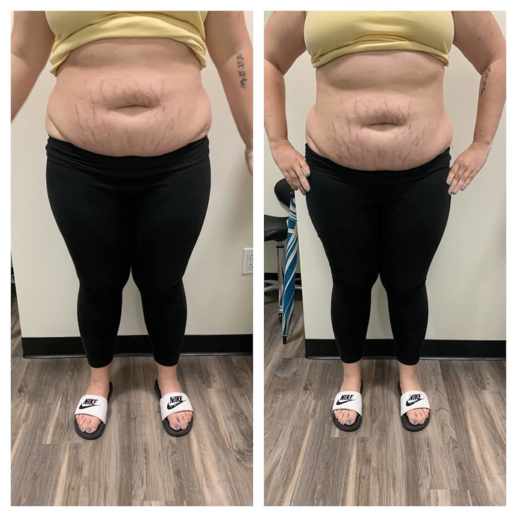 before and after body contouring Chicago