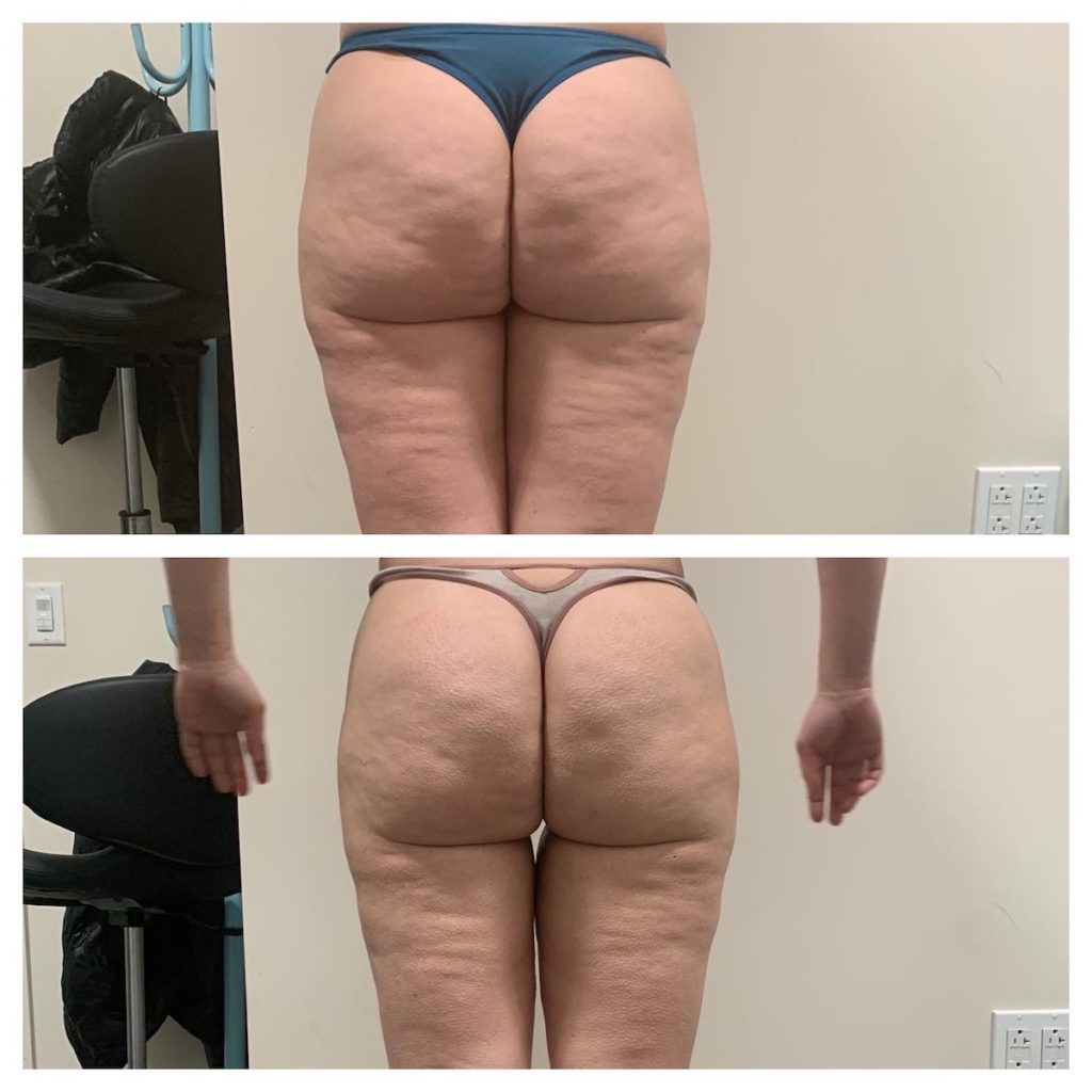 cellulite treatment Chicago body sculpting