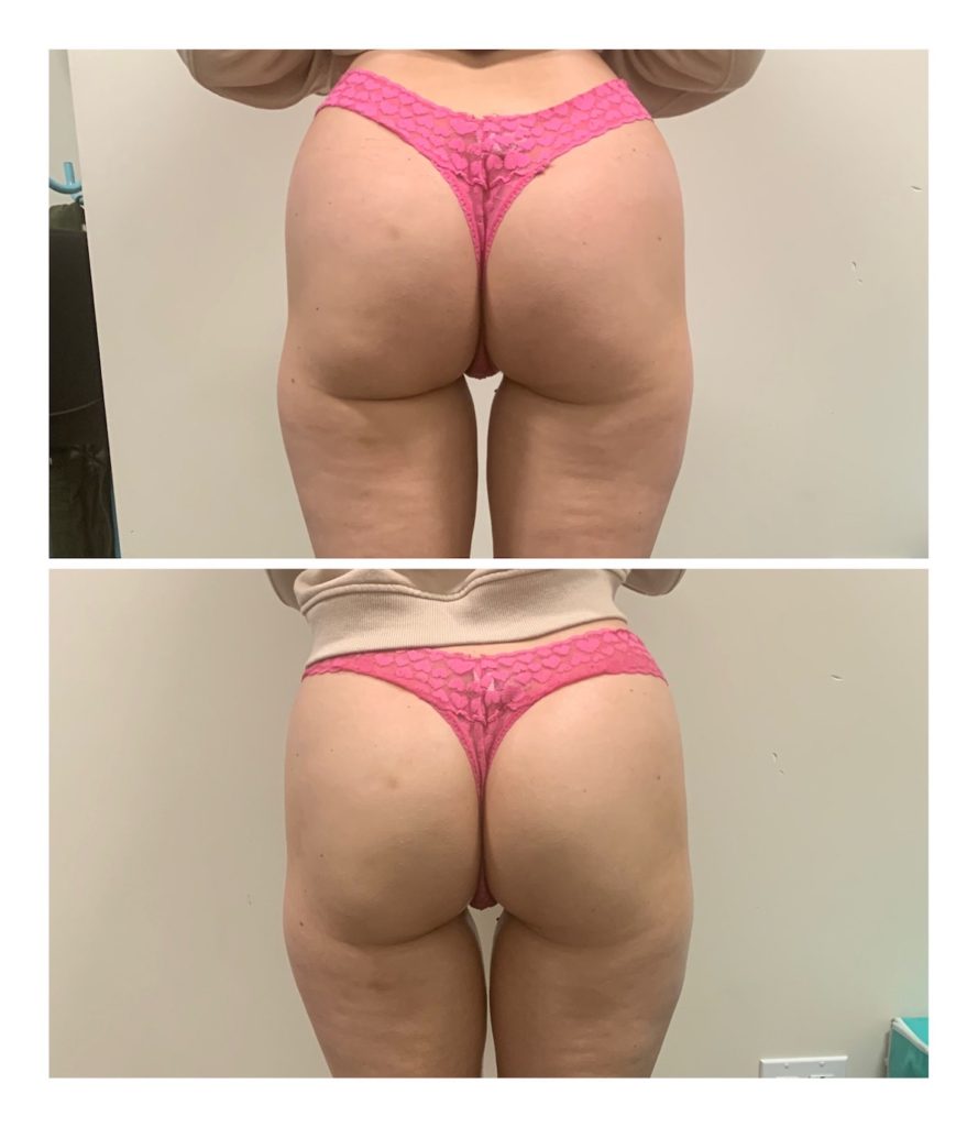 before after cellulite treatment