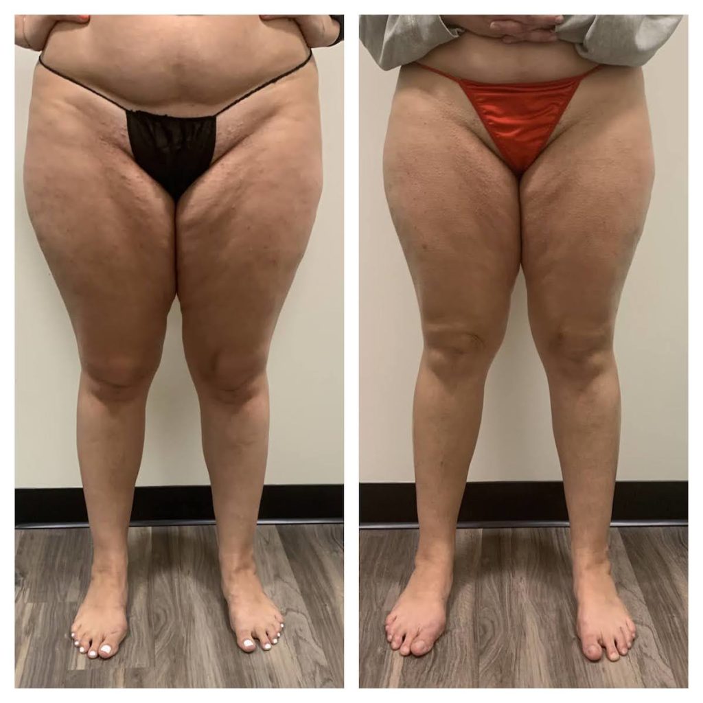 cellulite treatment Chicago