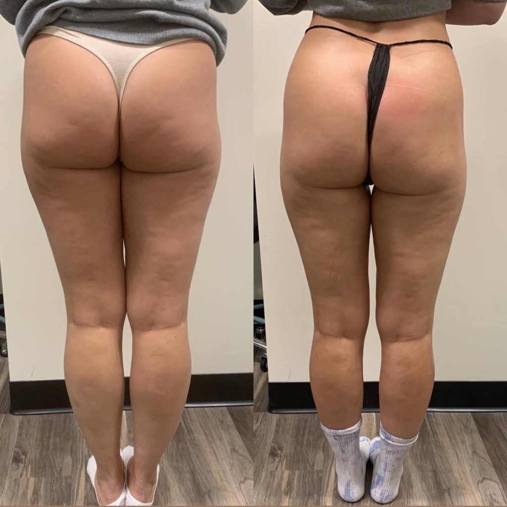 cellulite treatment Chicago body contouring before after