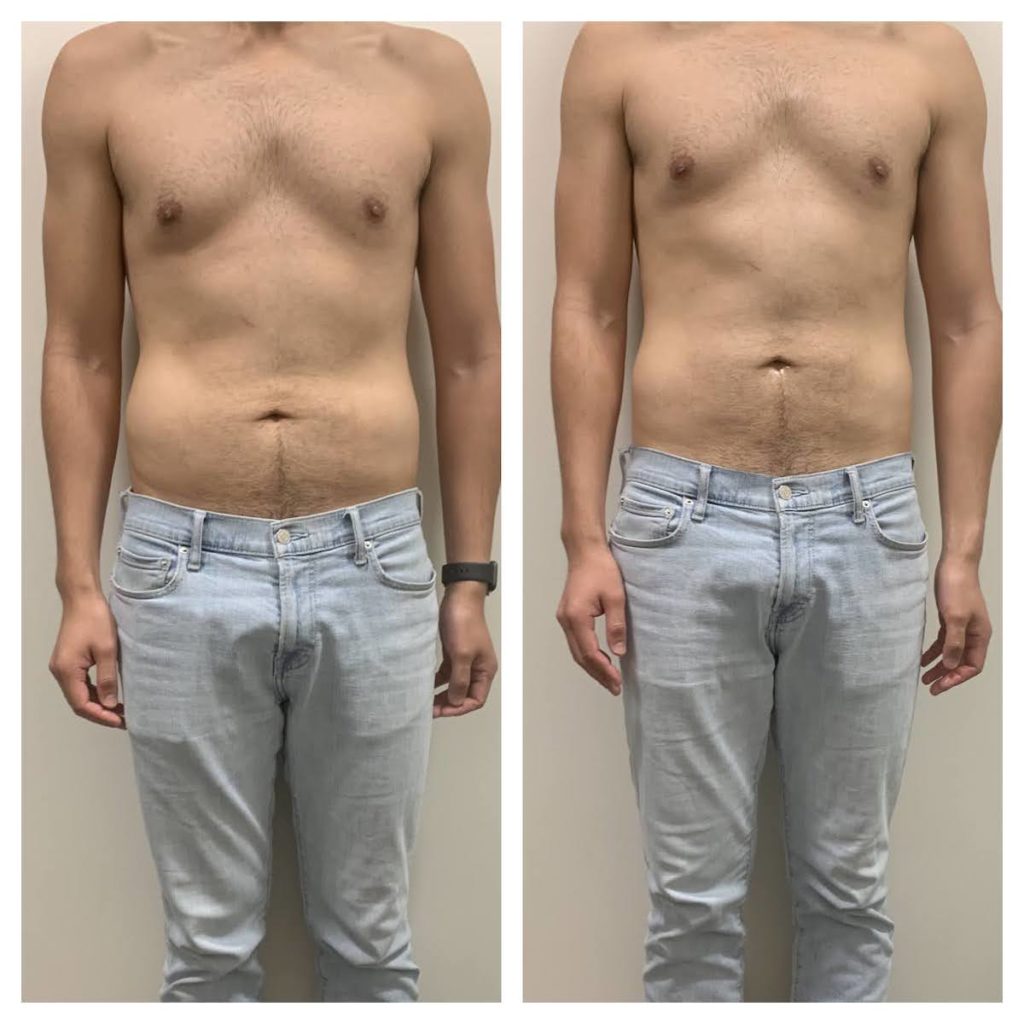 male body contouring Chicago before after