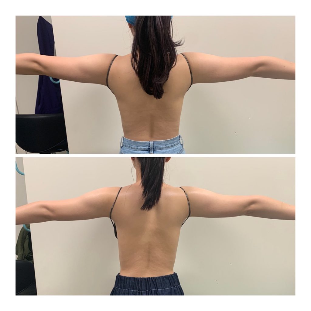 radiofrequency skin tightening arms