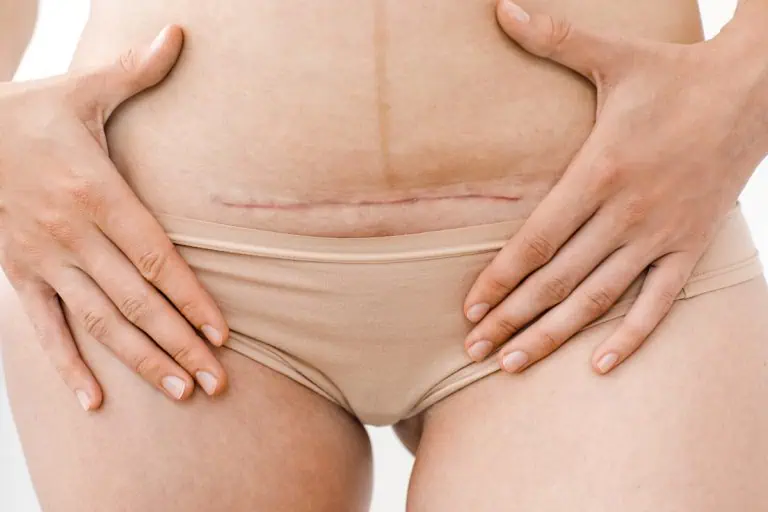 Body Contouring After C Section: 3 Simple Safety Rules Before You Start