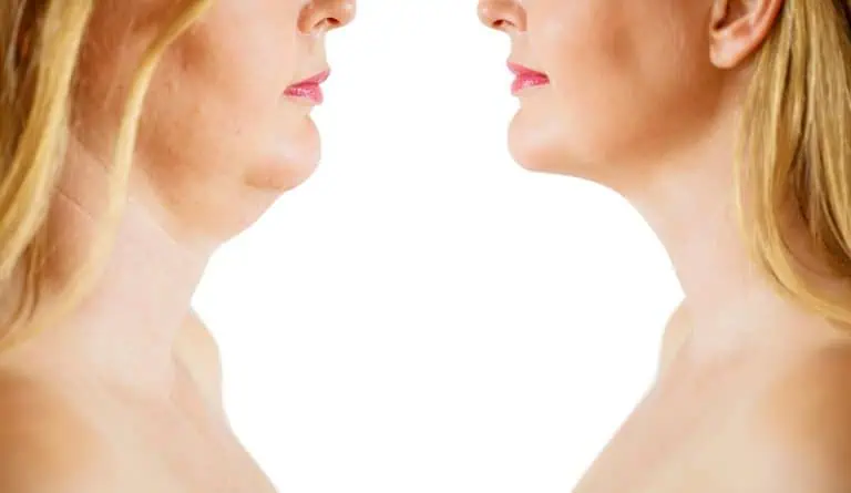Radiofrequency Double Chin Treatment: 4 Simple Reasons It Works