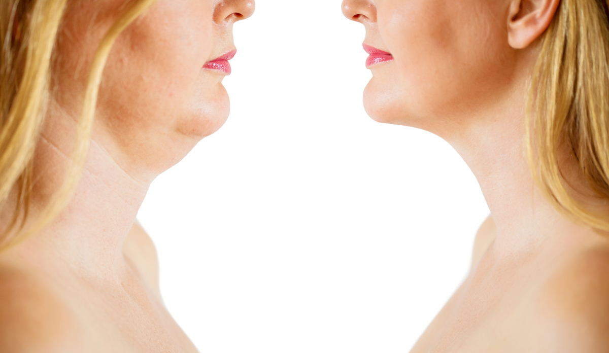 Can radiofrequency get rid of my double chin?