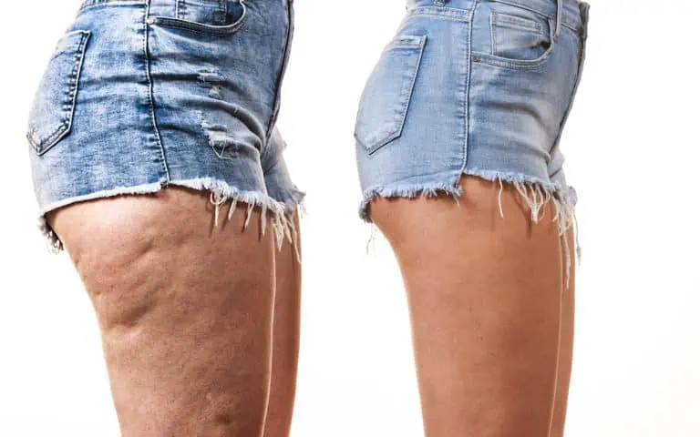 Body Contouring for Cellulite: 4 Simple Ways It Smooths Your Skin