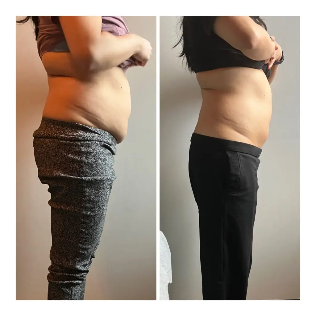 body contouring results ultrasonic cavitation radiofrequency