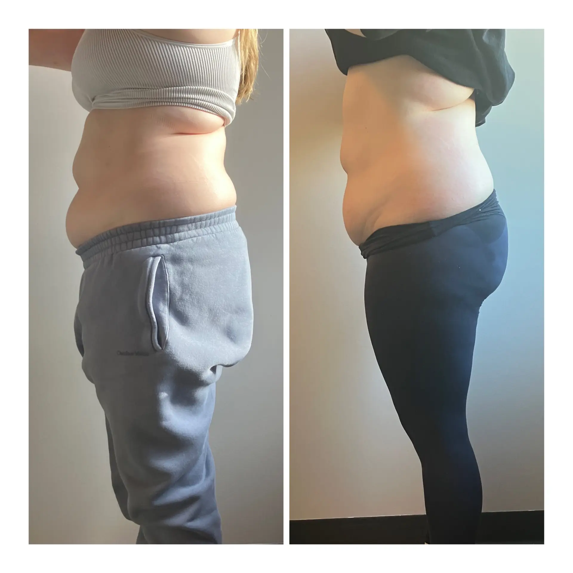 Before and after photo of body sculpting results with ultrasonic cavitation and radiofrequency treatment.