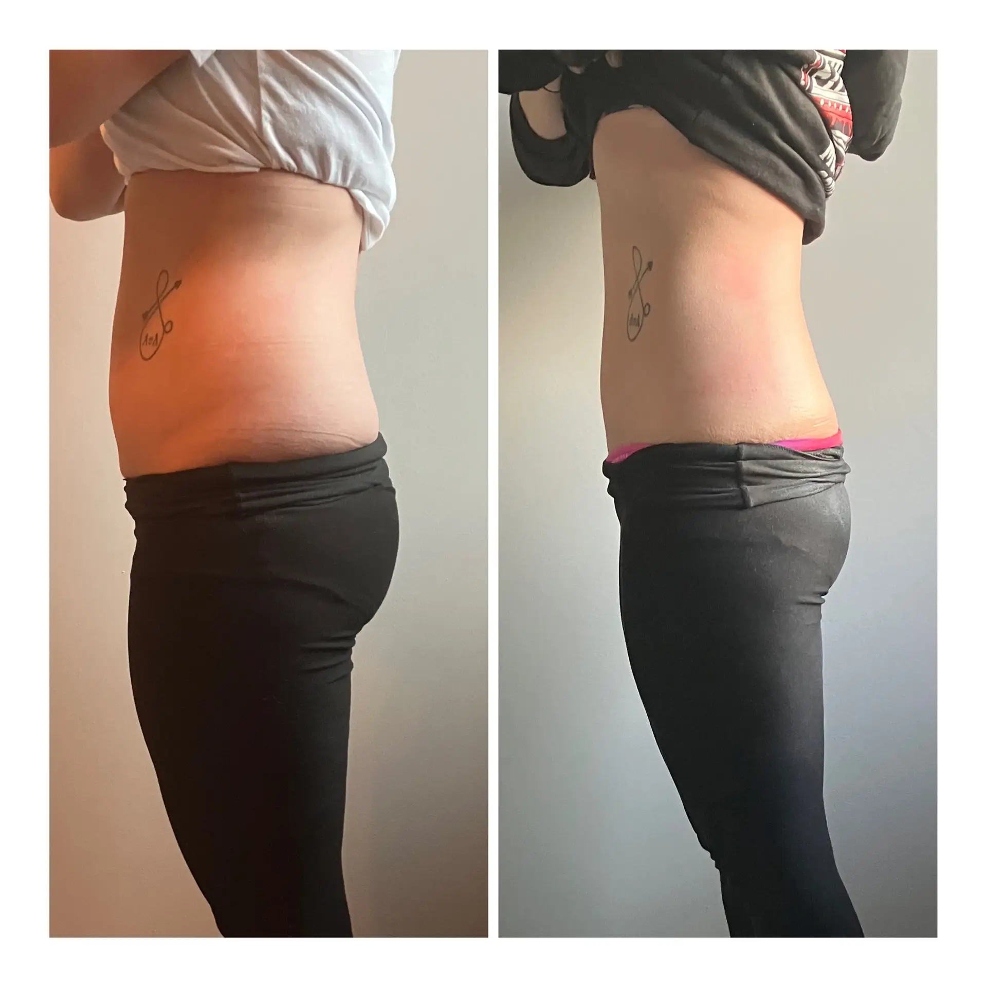 body contouring results ultrasonic cavitation radiofrequency
