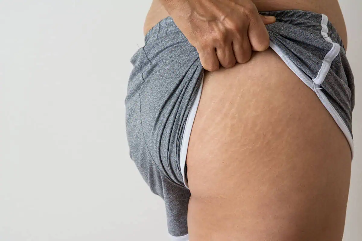 Radiofrequency for Stretch Marks: 3 Simple Things to Know Before You Try It