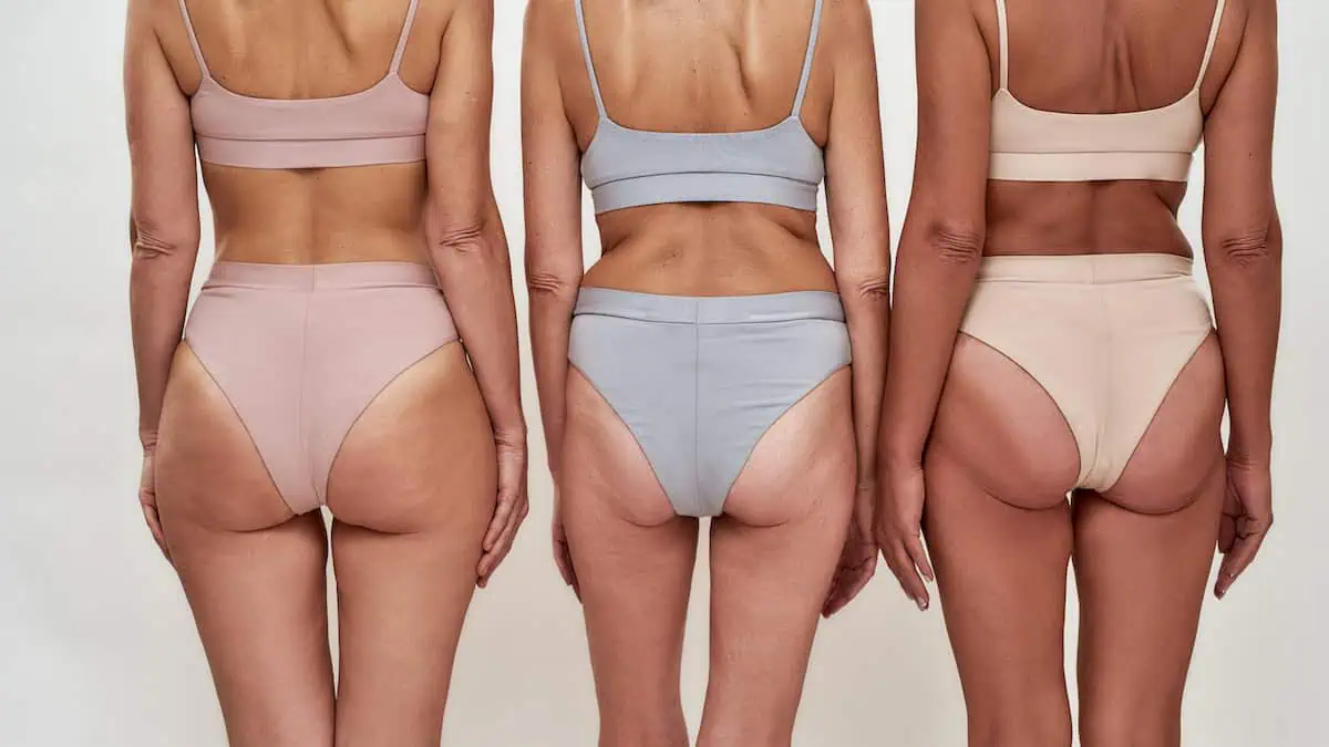 Does Cellulite Get Worse With Age? 3 Simple Reasons and What Helps