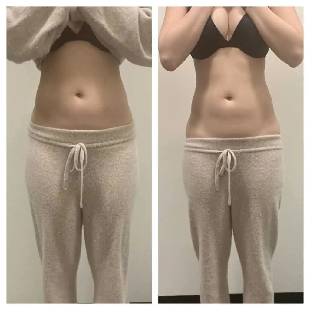 body contouring for stomach: before and after inch loss