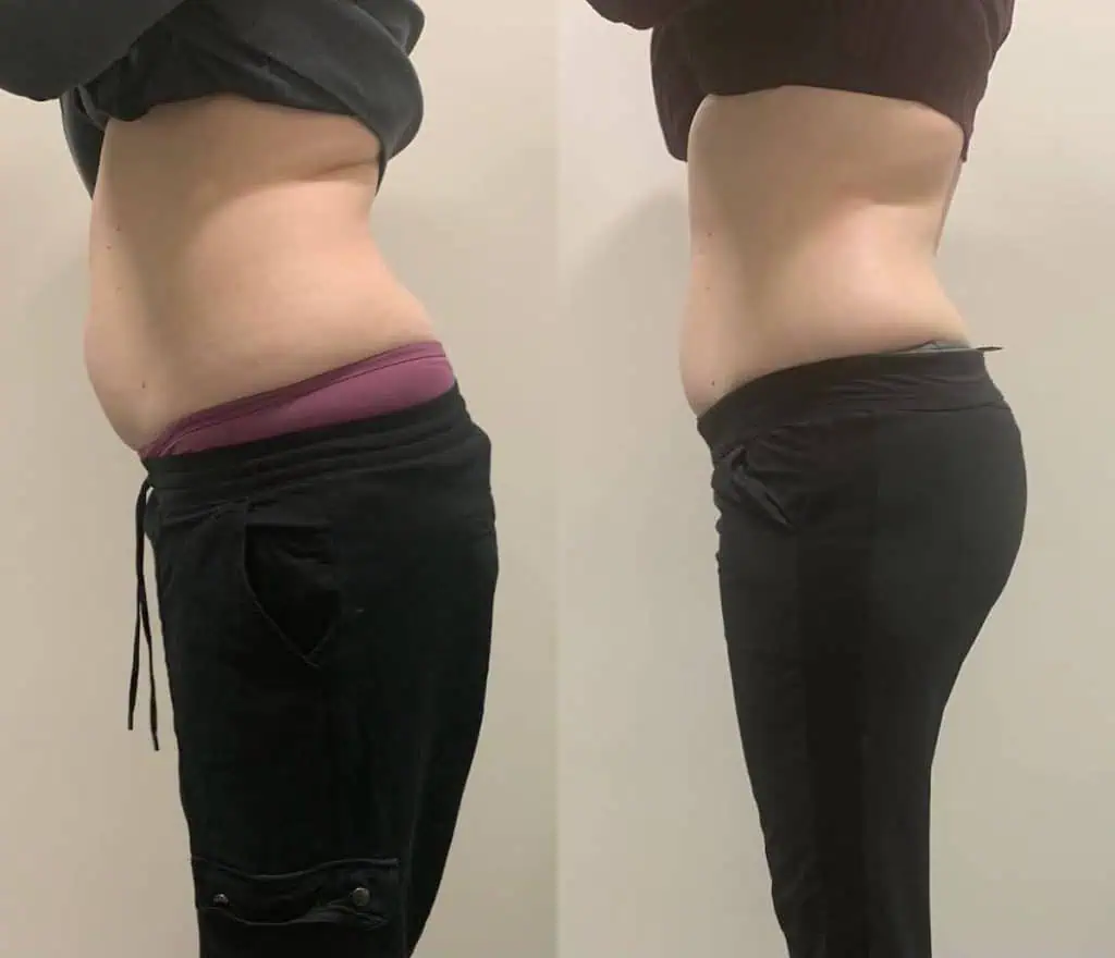body contouring for stomach: client result