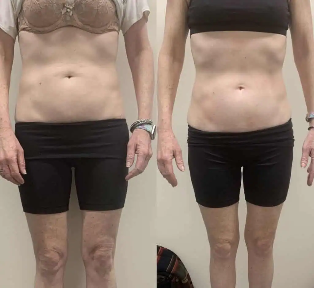 body contouring for stomach: client result