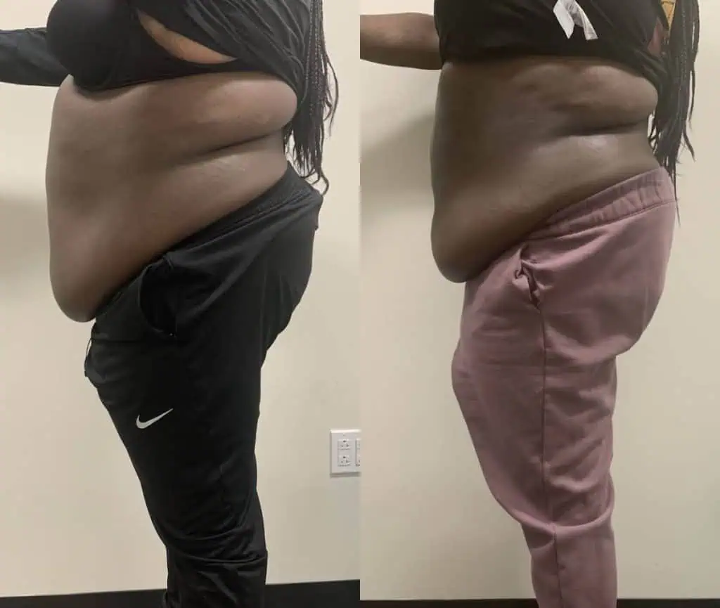 body contouring for stomach: client result