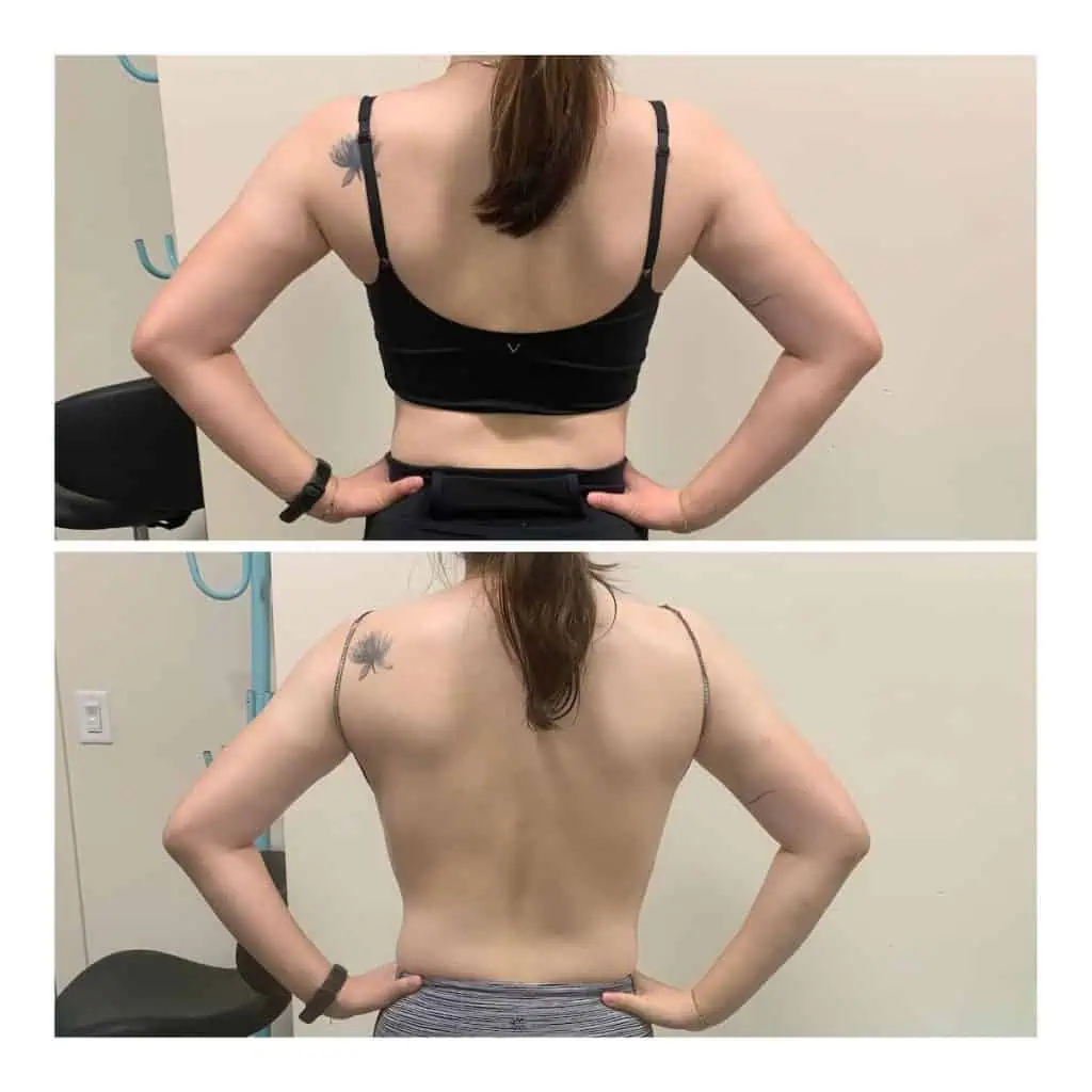 how to tighten loose skin on arms with radiofrequency at home