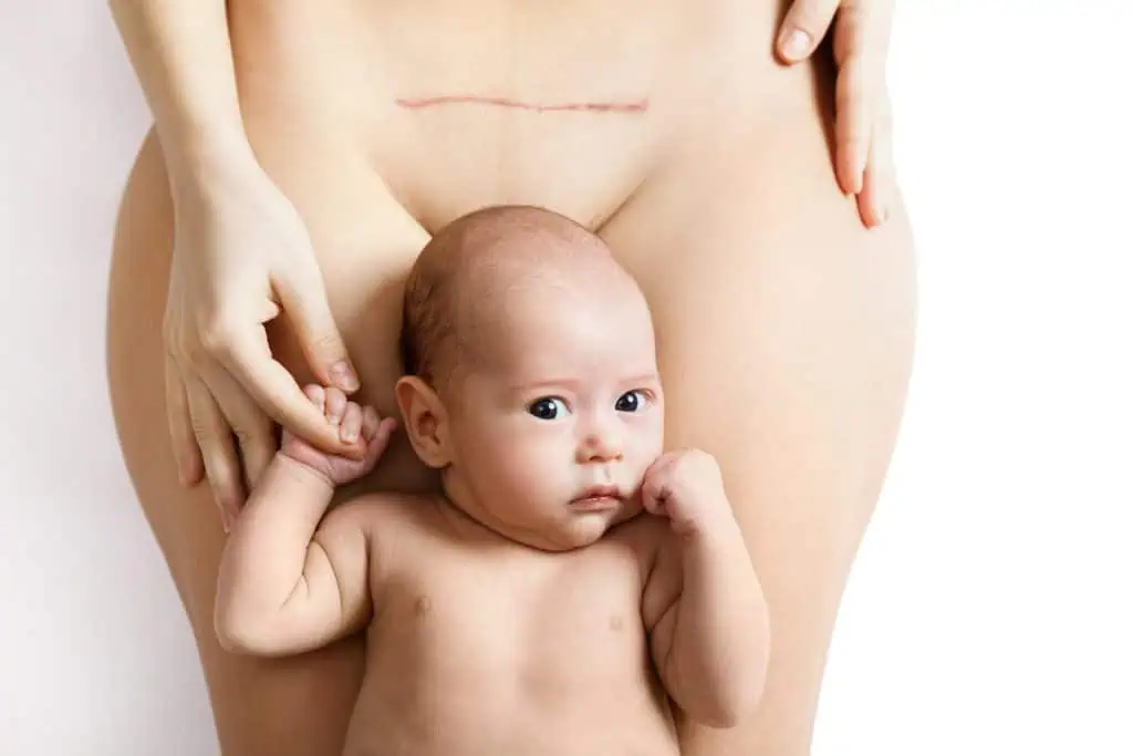 body contouring after c section
