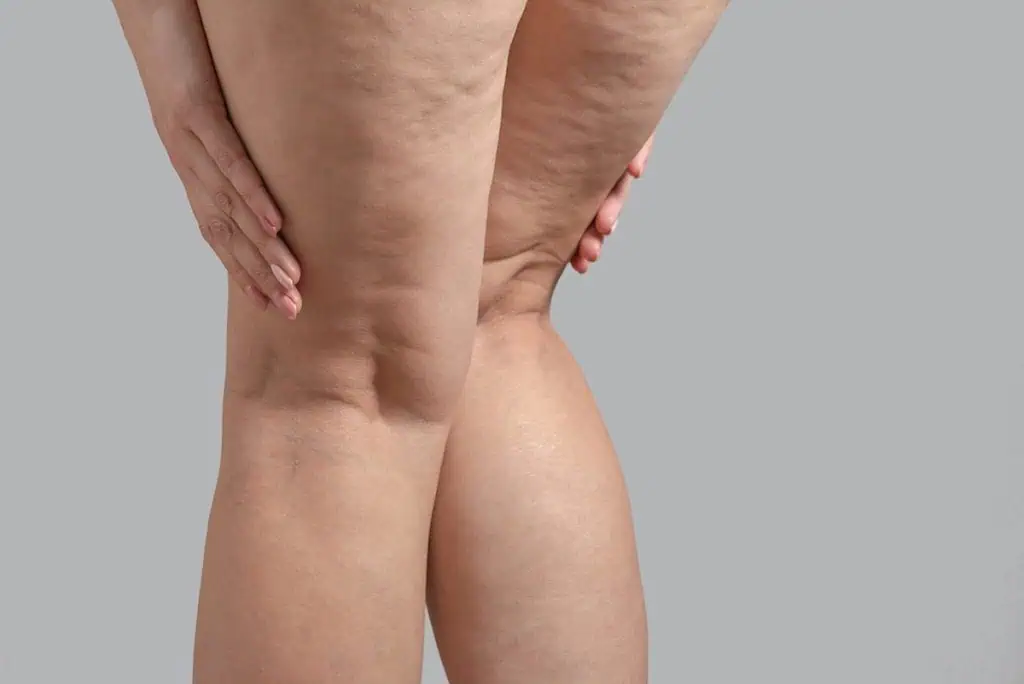 radiofrequency for cellulite at TushToners