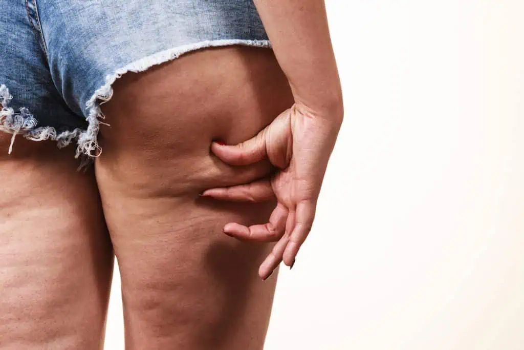 how to get rid of cellulite on thighs: body contouring treatment