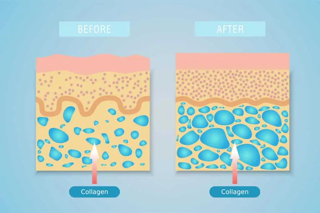 Collagen and cellulite weight loss Chicago
