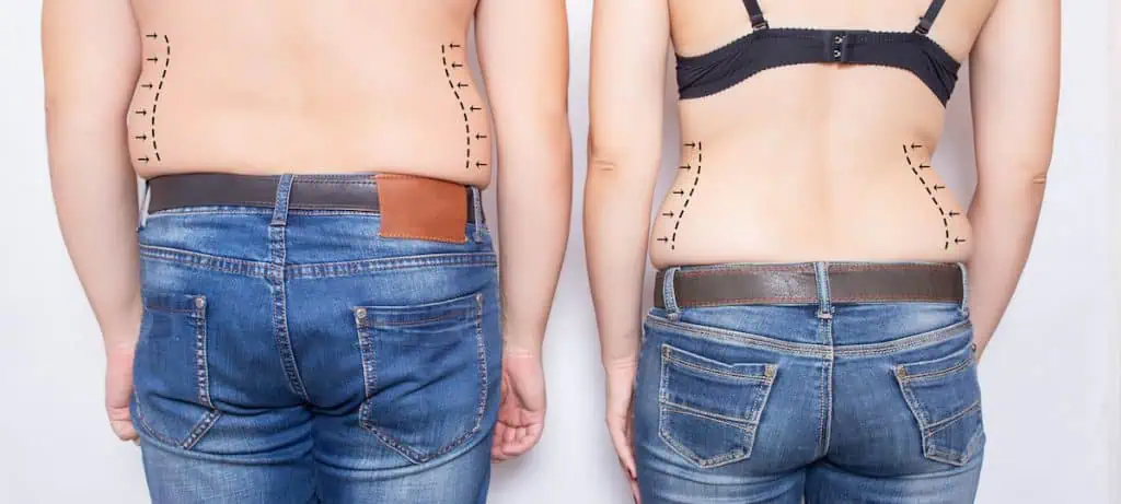 liposuction risks: surgery versus non-invasive body contouring
