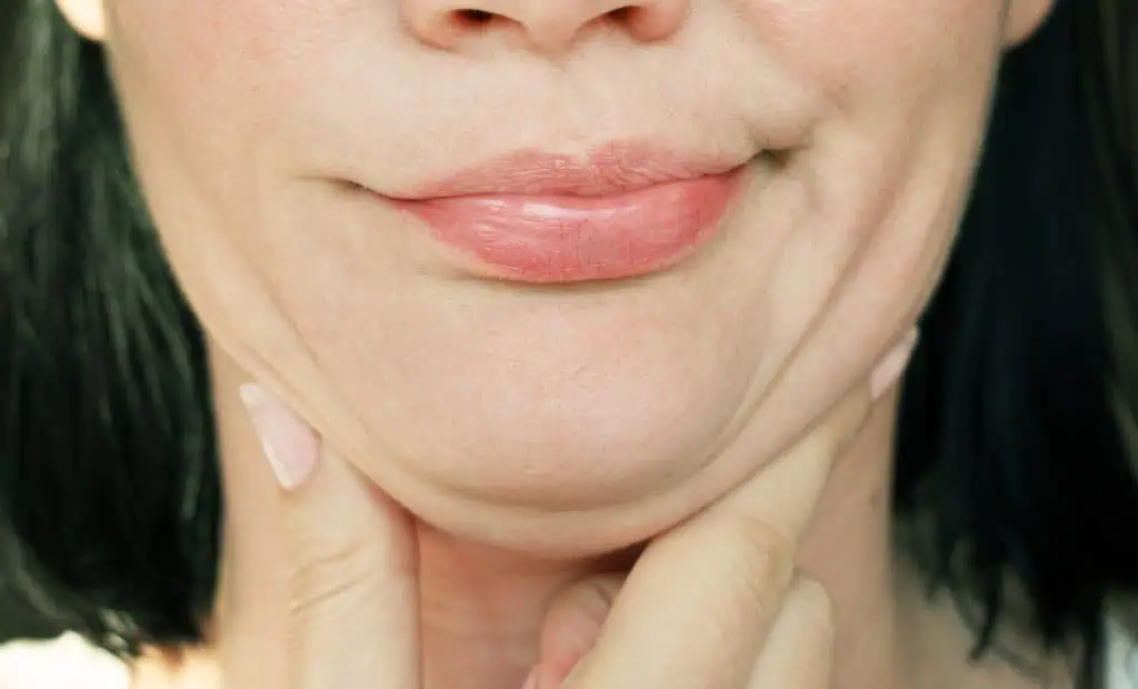 radiofrequency double chin treatment before and after