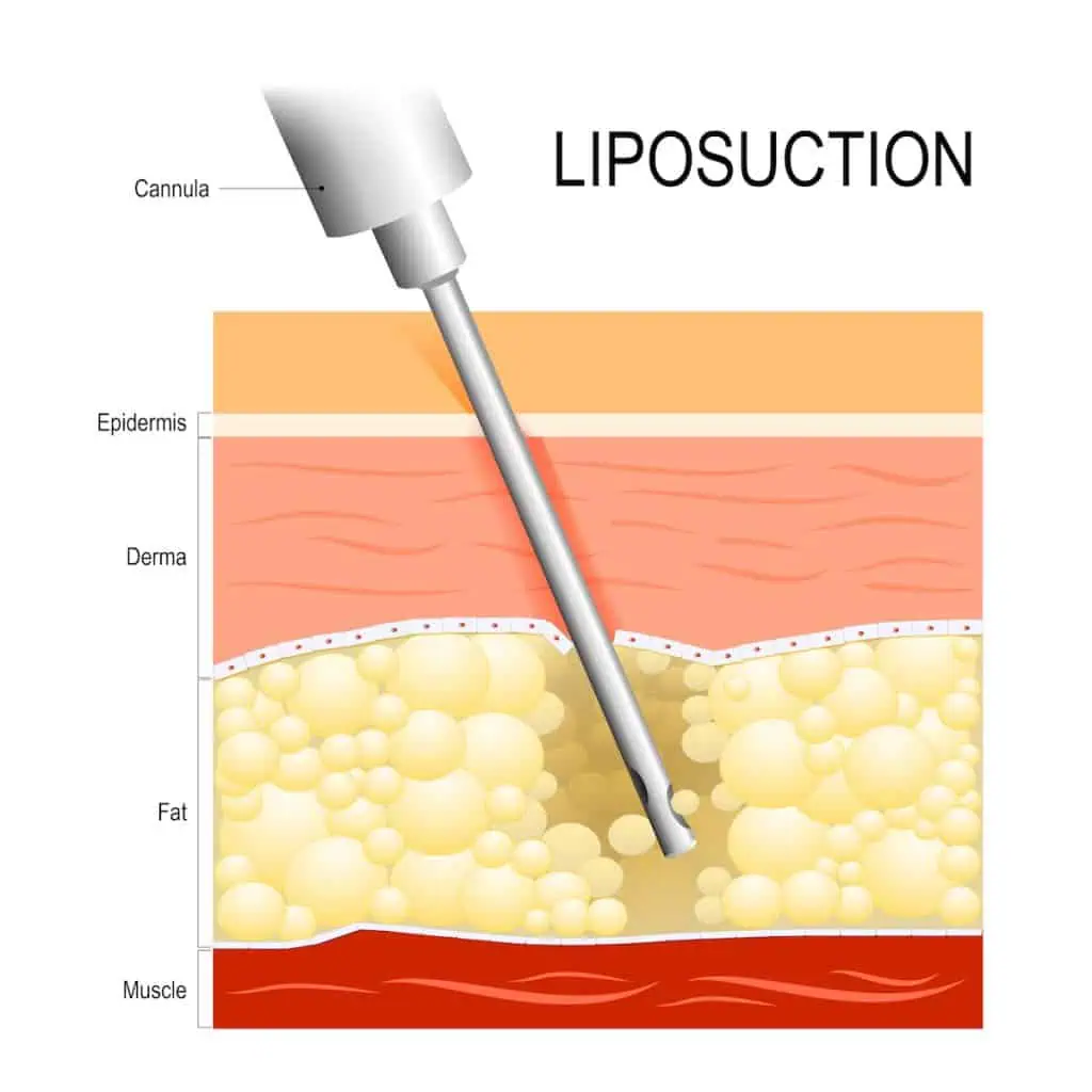 laser lipo vs liposuction at TushToners