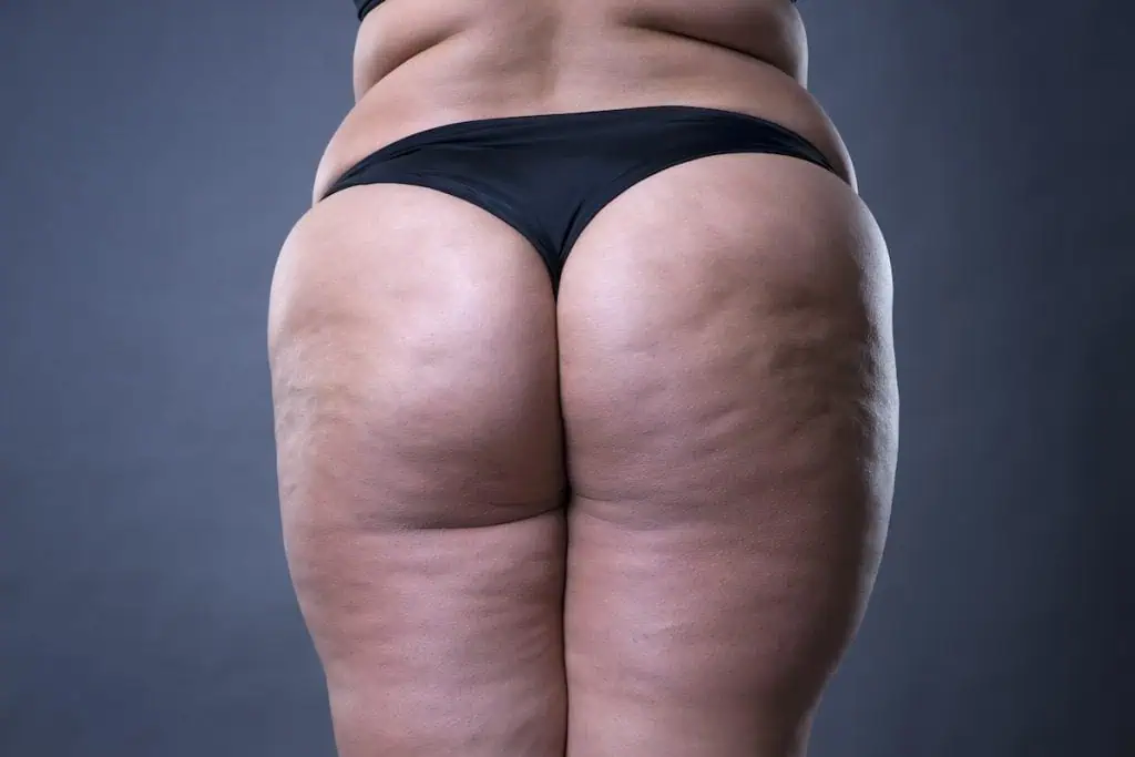 ultrasonic cavitation benefits: treatment at TushToners