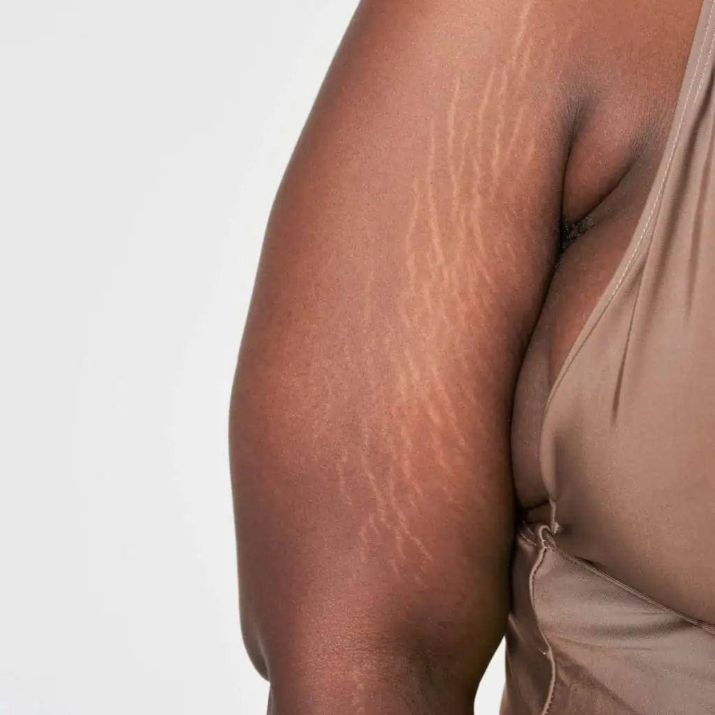 radiofrequency skin tightening arm fat chicago