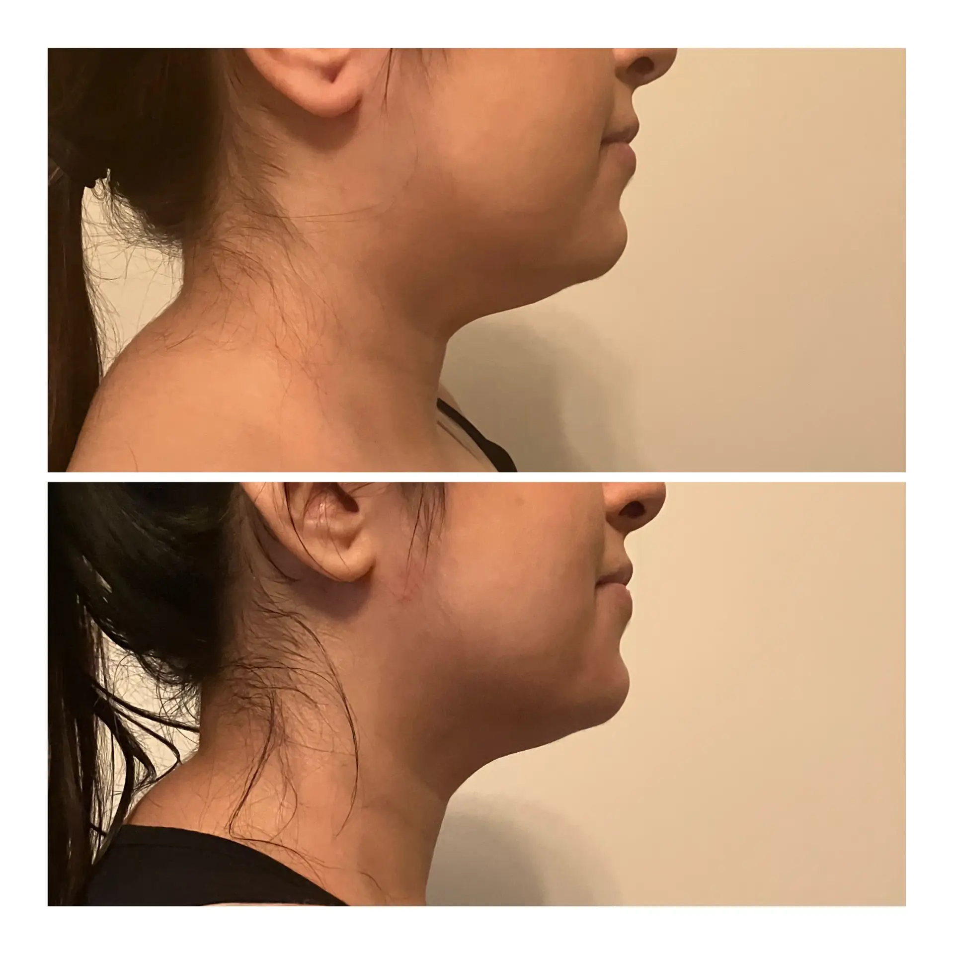body contouring results radiofrequency jawline treatment double chin