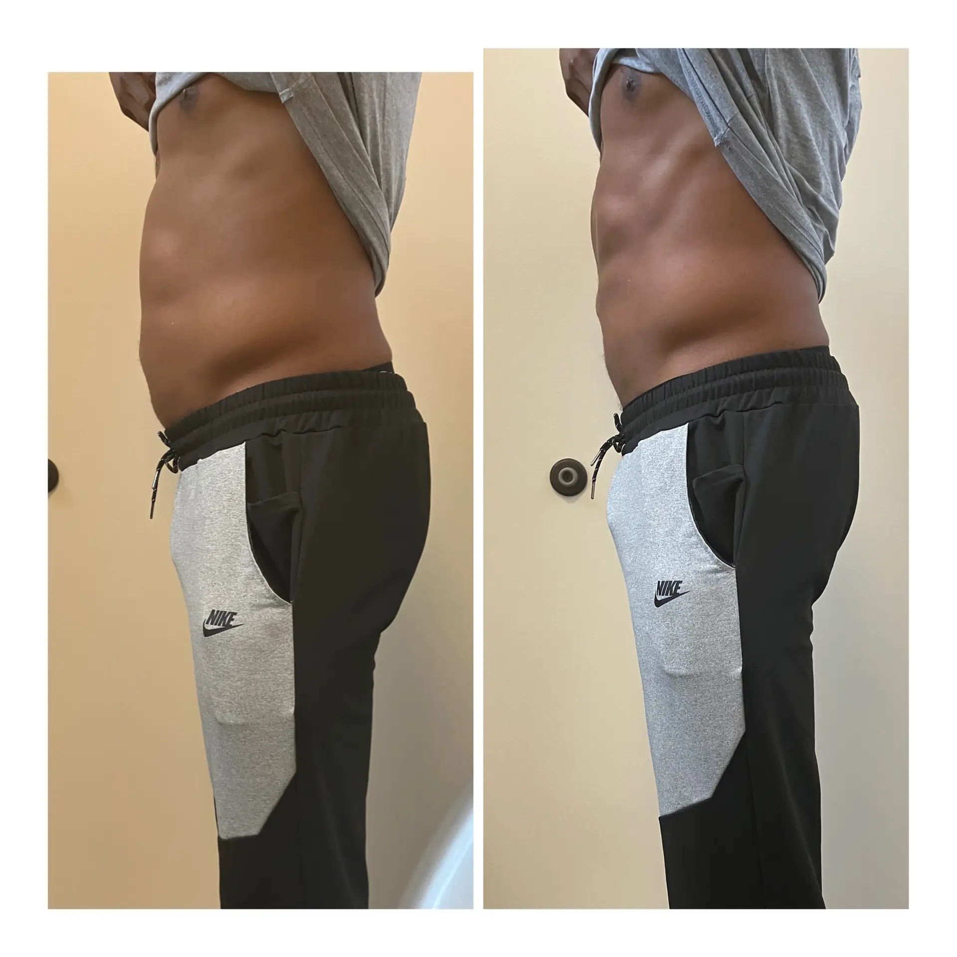 body contouring results ultrasonic cavitation radiofrequency