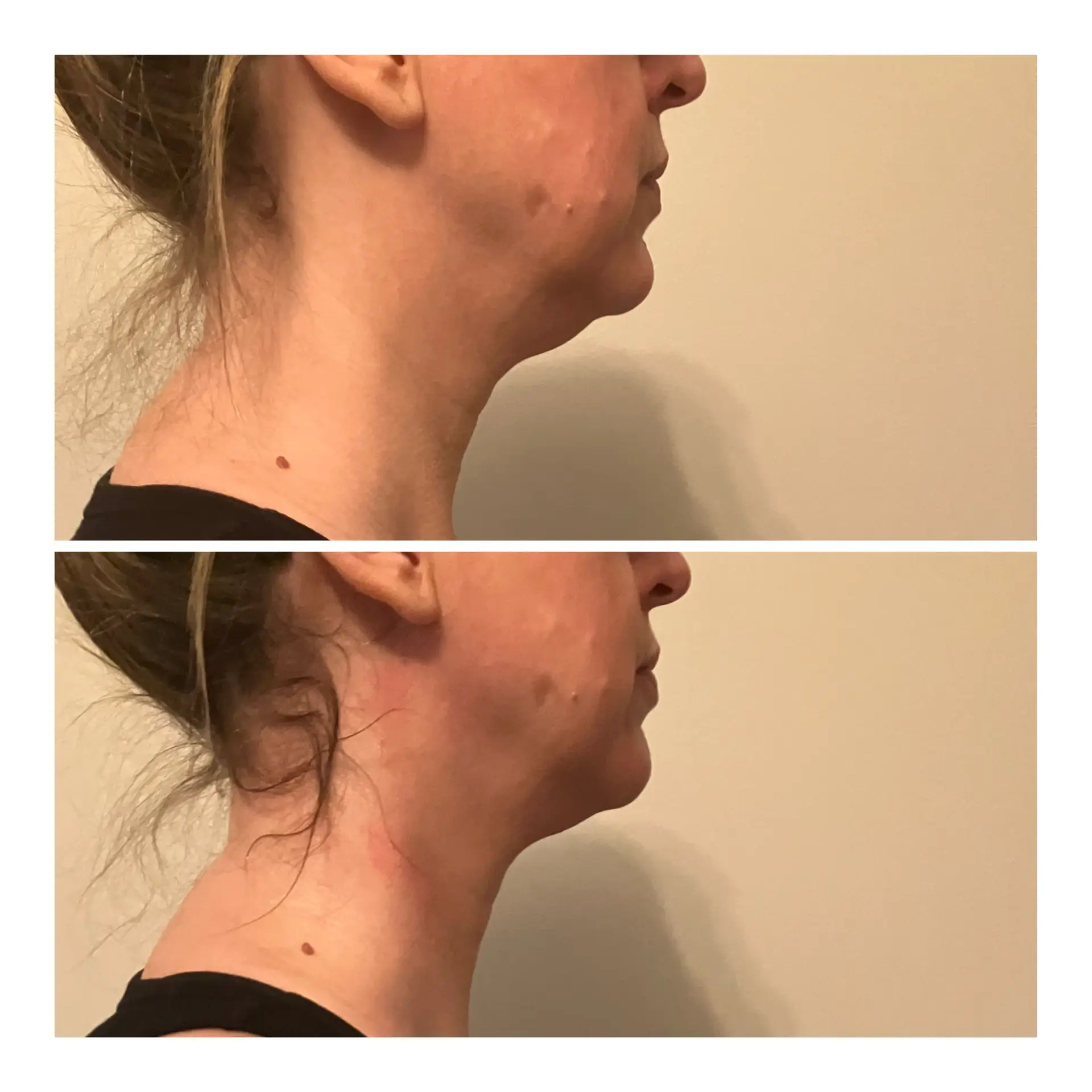 body contouring results radiofrequency jawline treatment double chin