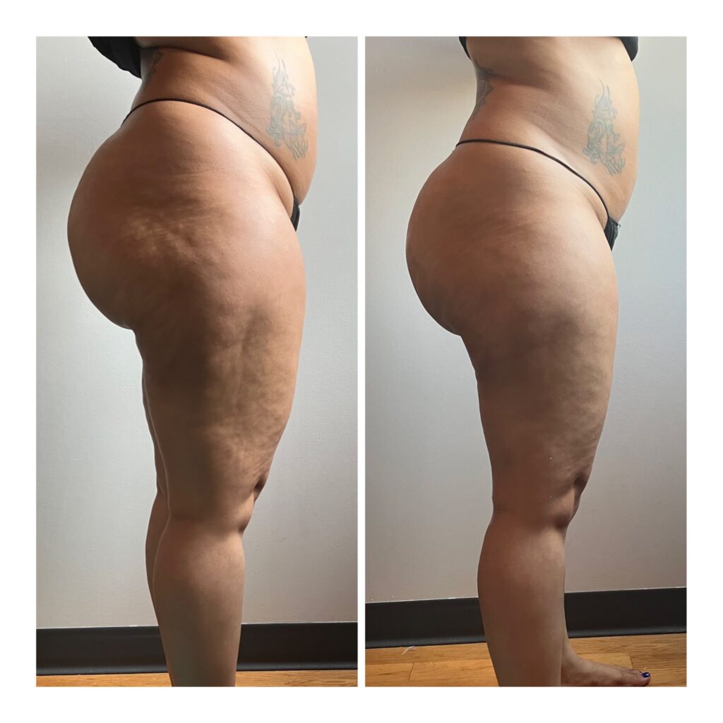 before and after TushToners Body Sculpting cellulite treatment