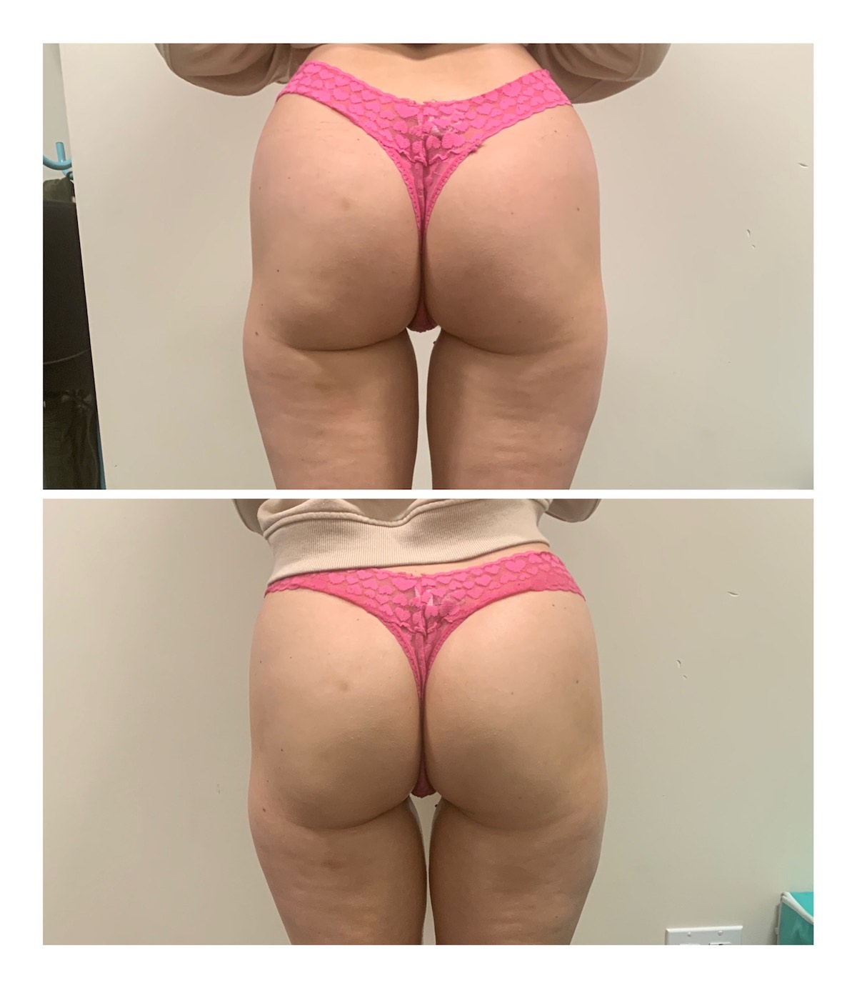before after cellulite treatment