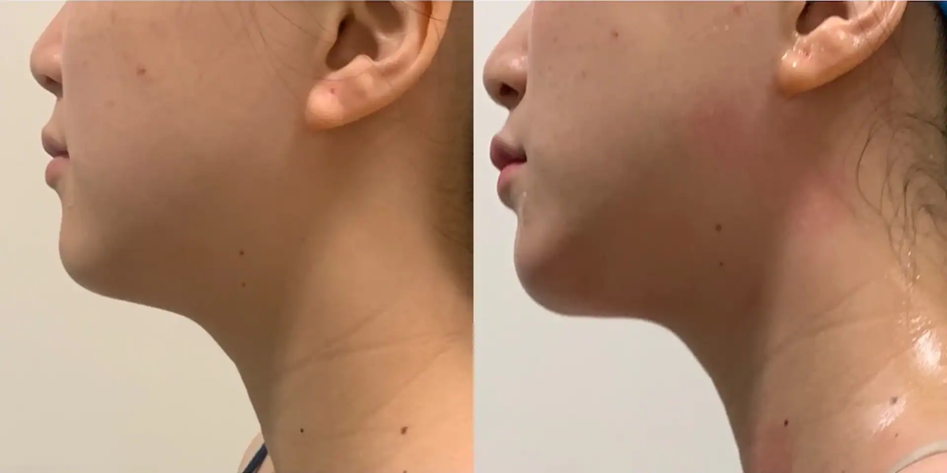 Double chin before and after: 24 years · three 15-min sessions