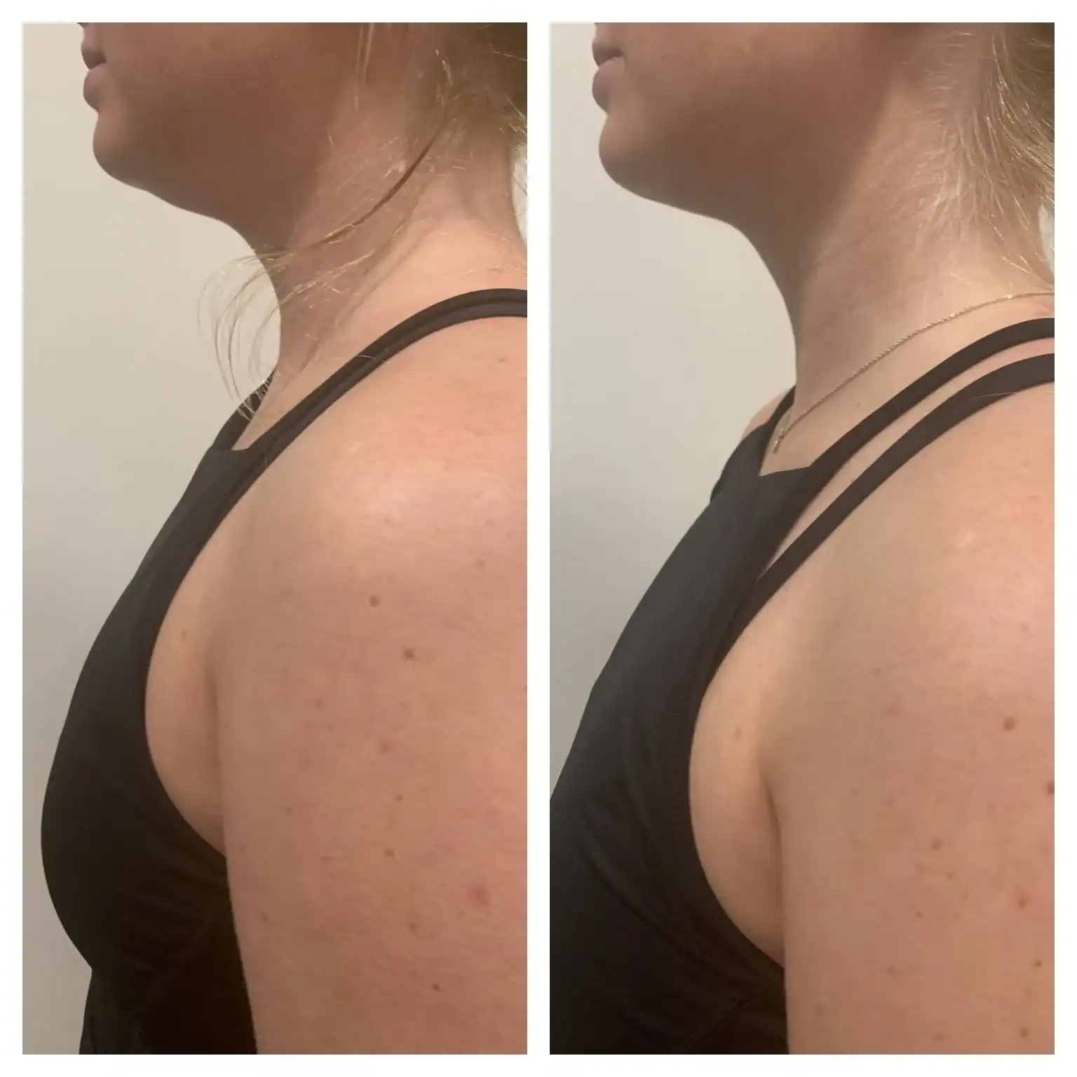 Double chin before and after: 26 years · one 15-min session