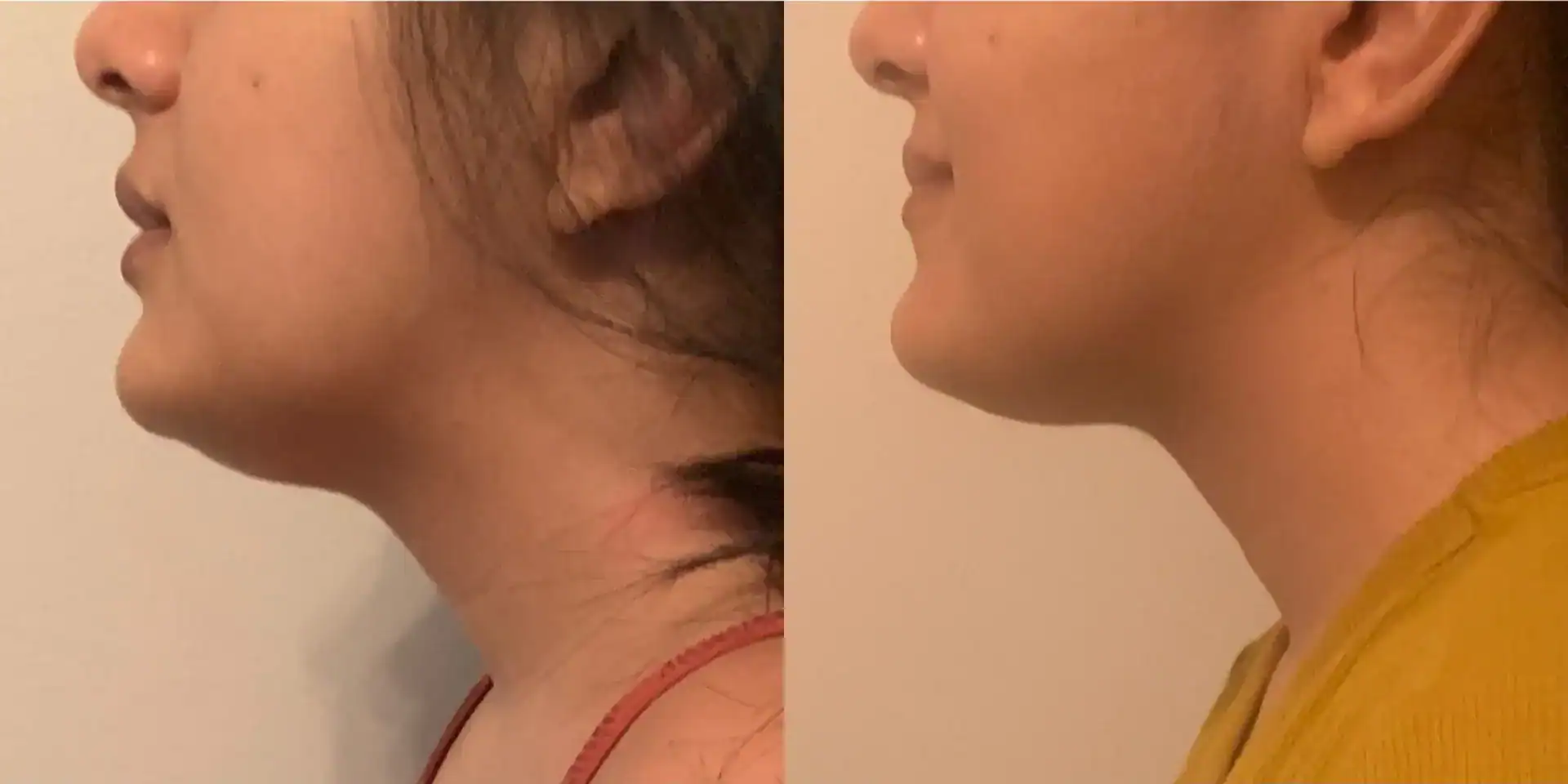 Double chin before and after: 28 years · two 15-min sessions