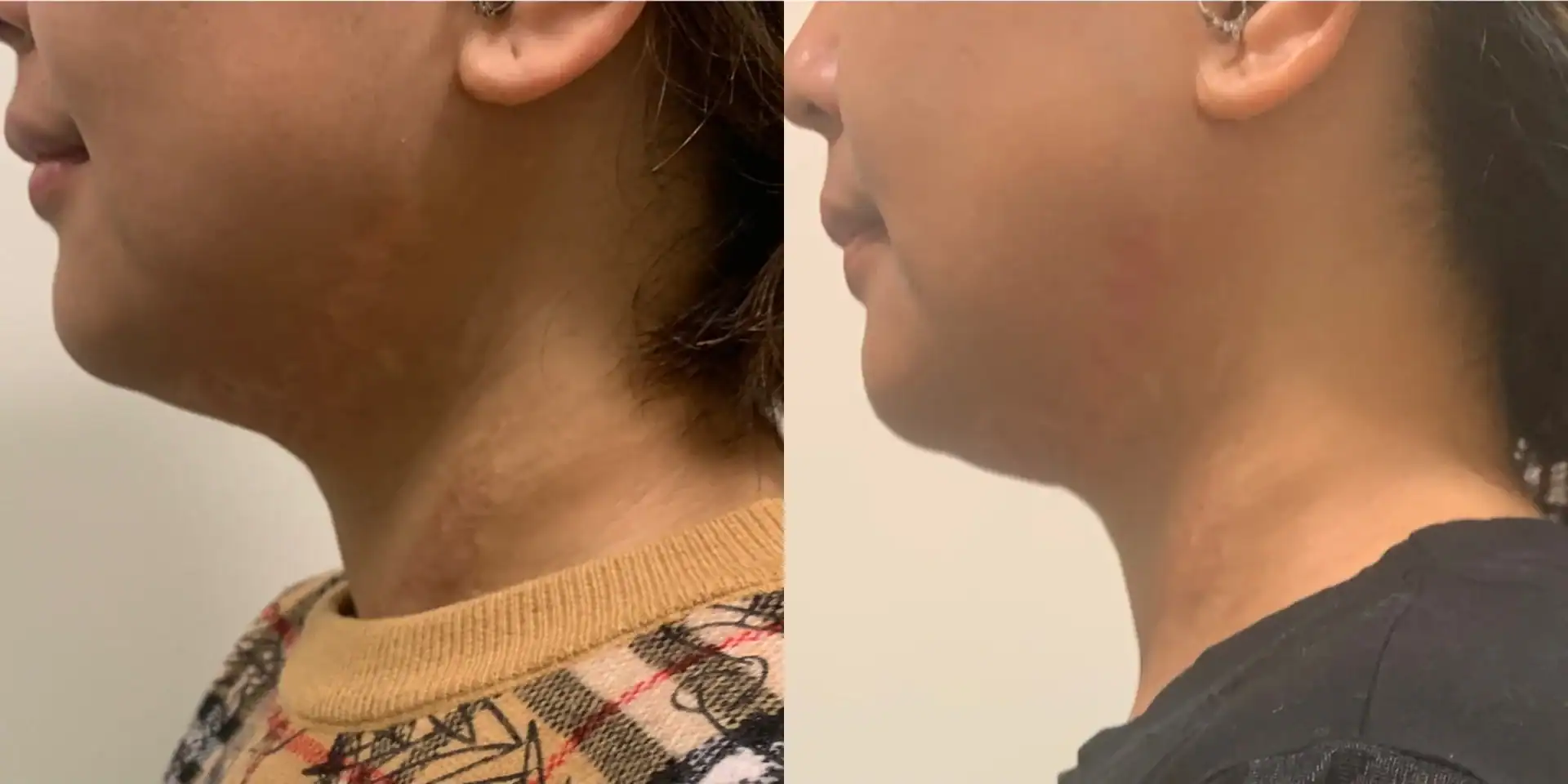 Double chin before and after: 38 years · two 15-min sessions