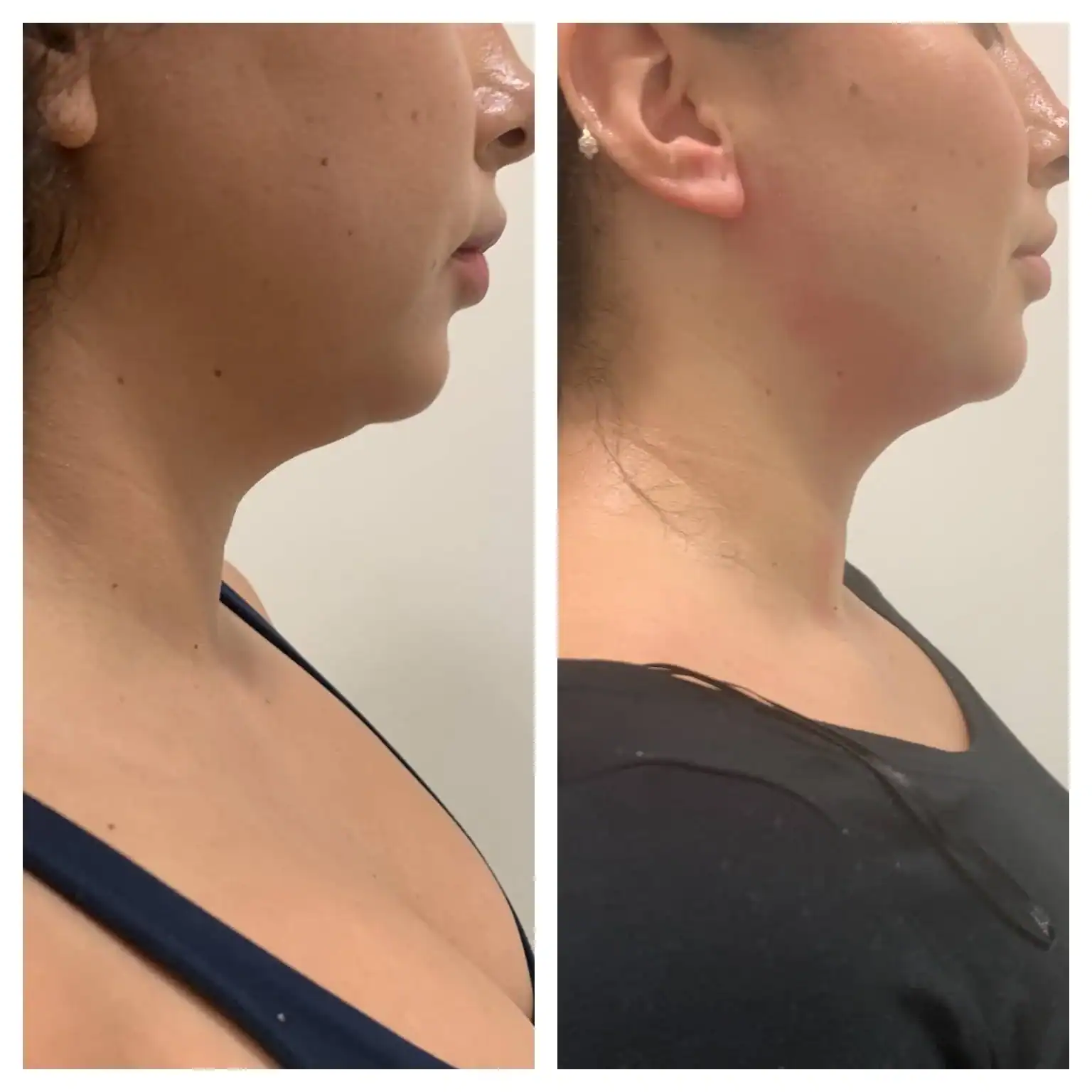 Double chin before and after: 45 years · three 15-min sessions